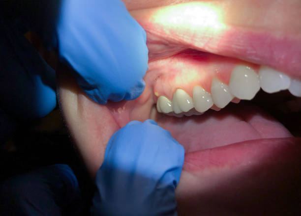 Best Cracked Tooth Emergency Dentist  in Southwest Ranches, FL